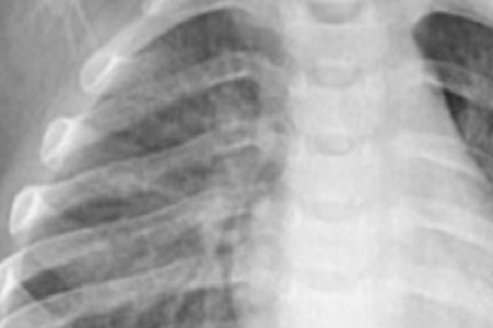Бързо откриване на Chlamydia pneumoniae: надеждно и ефективно